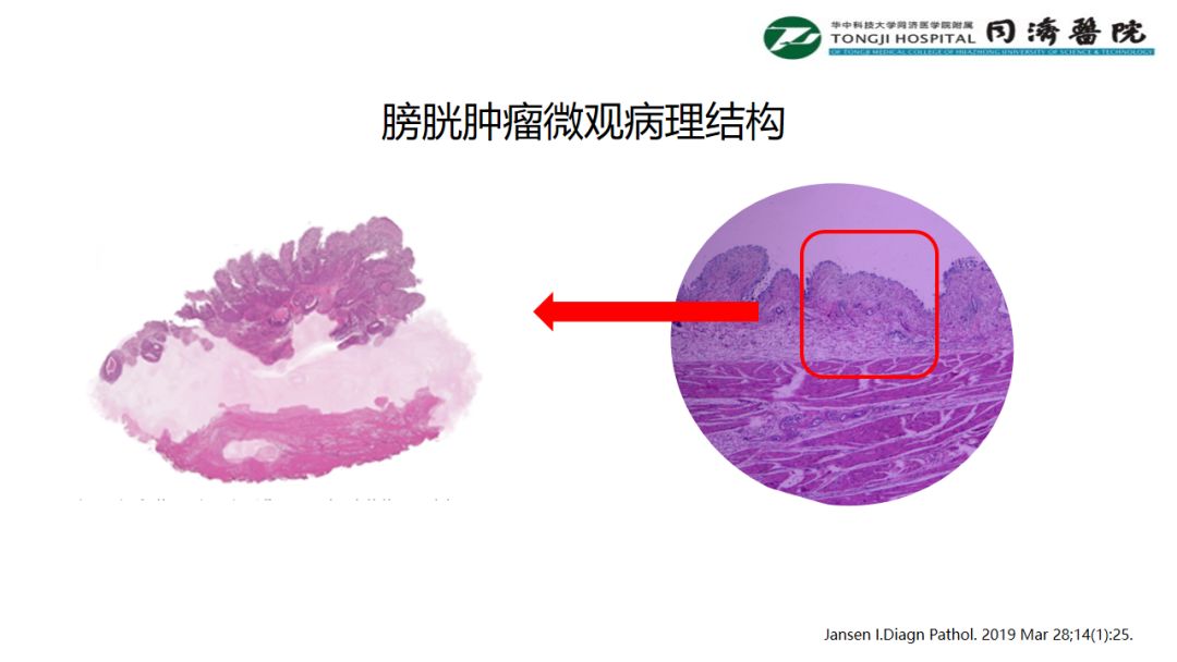 铥激光手术视频大赛-膀胱肿瘤微观病理结构