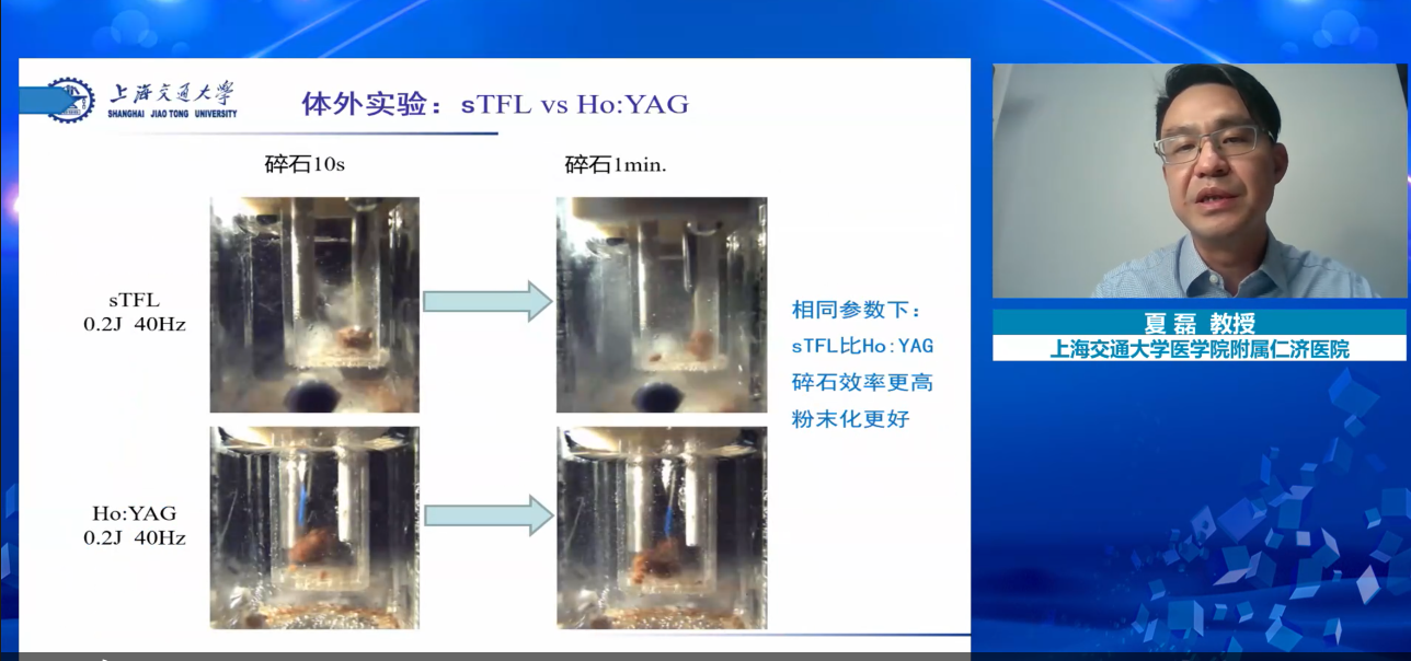 超脉冲光纤铥激光是一种安全有效的碎石激光器,Ho:YAG作为碎石激光,铥激光,医用铥激光,瑞柯恩