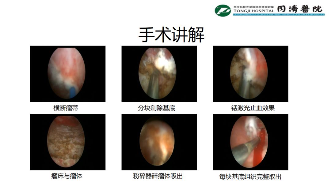 铥激光手术视频大赛-手术讲解