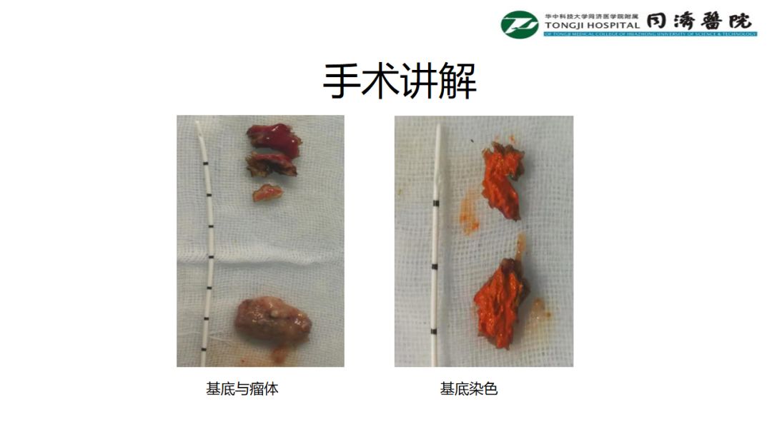 铥激光手术视频大赛-手术讲解
