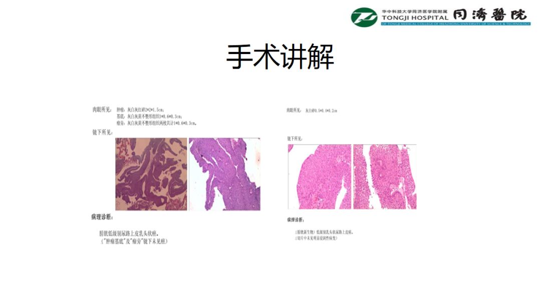 铥激光手术视频大赛-手术讲解