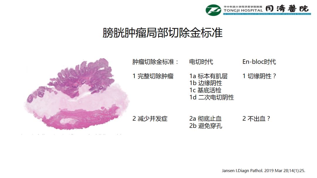 铥激光手术视频大赛-膀胱肿瘤局部切除金标准