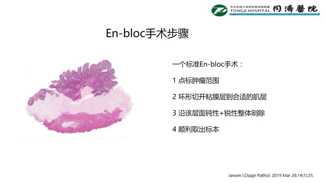 铥激光手术视频大赛-En-bloc手术步骤