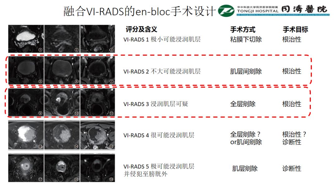 铥激光手术视频大赛,融合VI-RADS与en-bloc手术设计