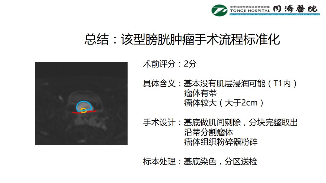 铥激光手术视频大赛总结：该型膀胱肿瘤手术流程标准化
