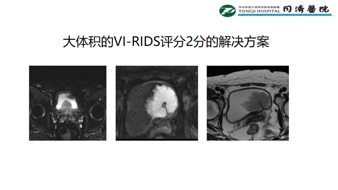 铥激光手术视频大赛,大体积的VI-RADS评分2分的解决方案