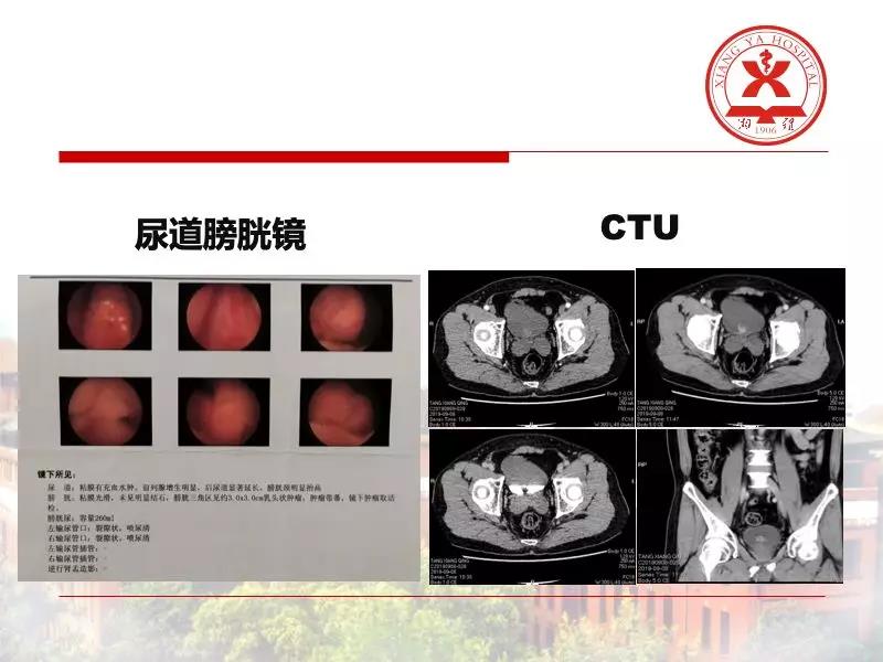瑞柯恩培训学院第5期,铥激光膀胱肿瘤整块切除术-王龙