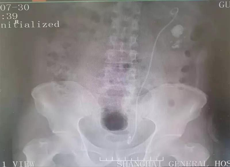 瑞柯恩培训,左输尿管软镜检查+钬激光碎石取石术