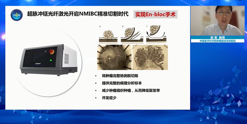 超脉冲光纤铥激光,NMIBC精准切割时代,铥激光,医用铥激光,瑞柯恩